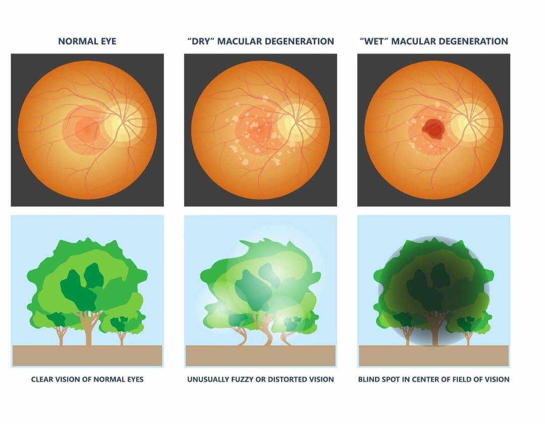 Age-Related Macular Degeneration (AMD)